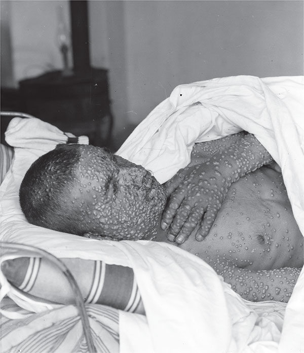 A smallpox patient like those in Muncie Indiana during the smallpox epidemic - photo 3