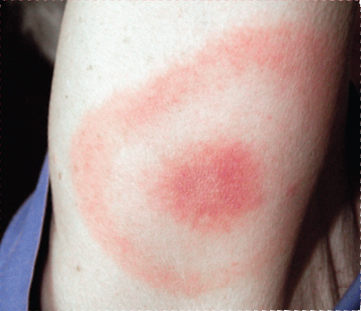 Image Credt CDCJames Gathany The picture shows an EM rash Eric identified - photo 4