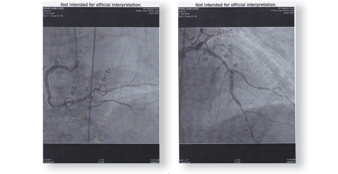 She said that for my case she would recommend me to have an open heart bypass - photo 2