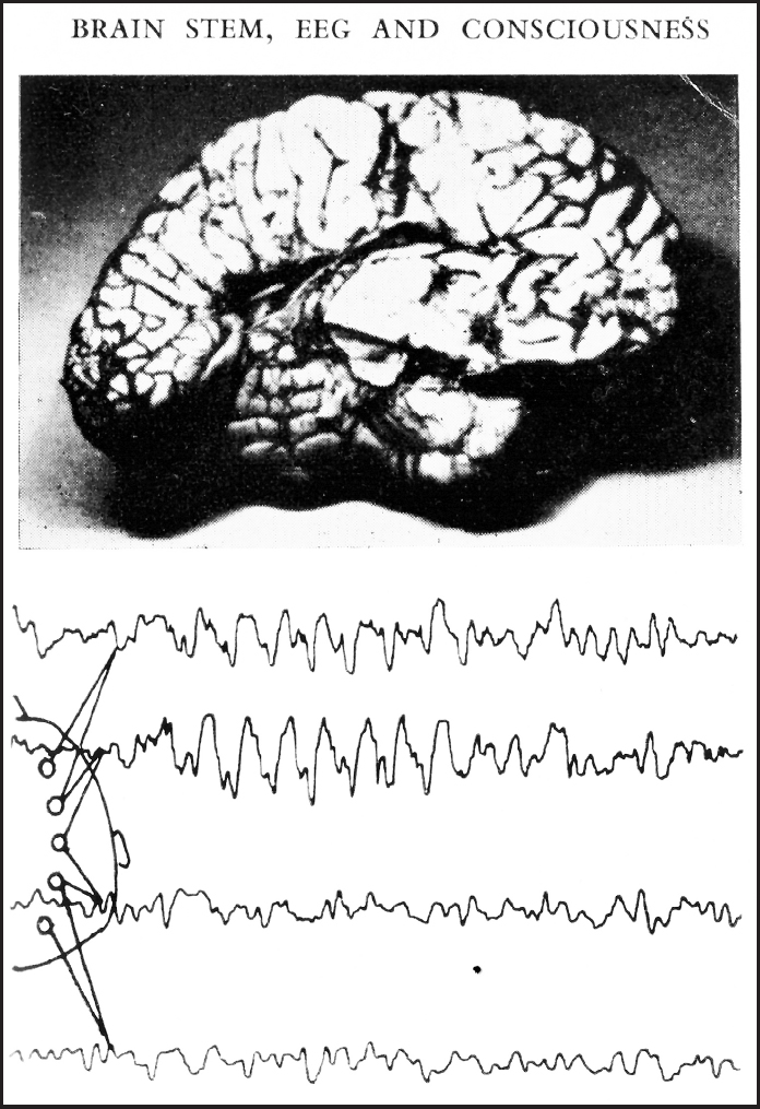 During the 1950s electroencephalography EEG readings became common features - photo 1