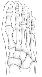 Normal foot Arthritic foot Treatment of Arthritis Arthritis is often - photo 3