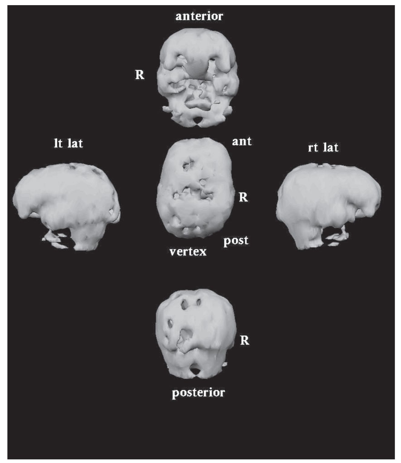 Initial 3-D NeuroSPECT imaging on patient HC Holes are multiple areas of - photo 2