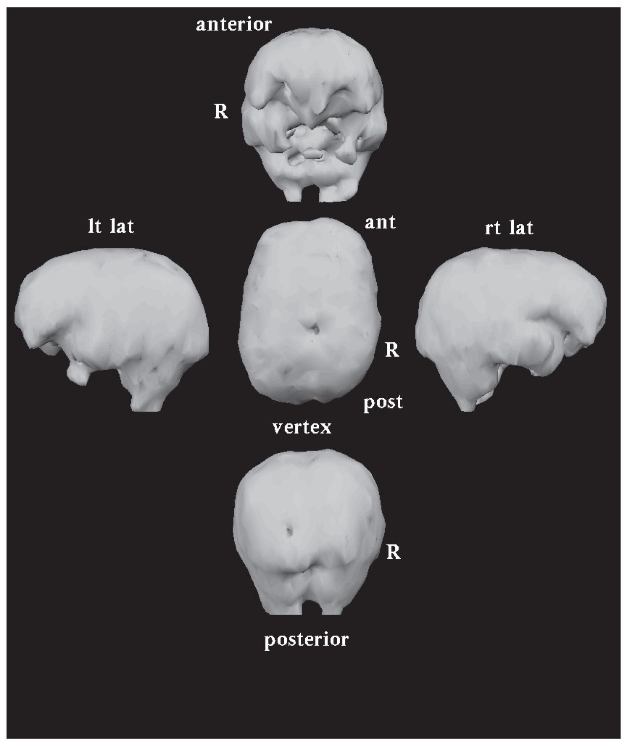 NeuroSPECT scan 25 years later after treatment with The Goldberg Approach - photo 3