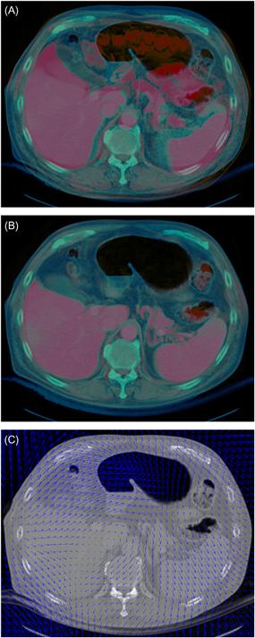 Figure 11 Computing organ motion via deformable registration A A - photo 4