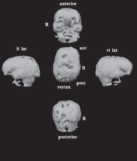 Initial 3-D NeuroSPECT imaging on patient with autism see Holes are - photo 3