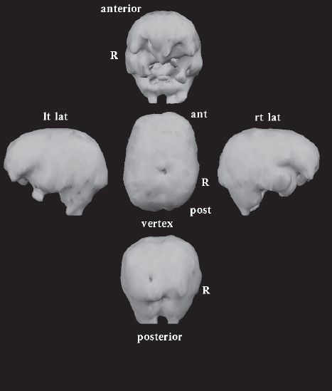 NeuroSPECT scan 25 years later after treatment with The Goldberg Approach - photo 4