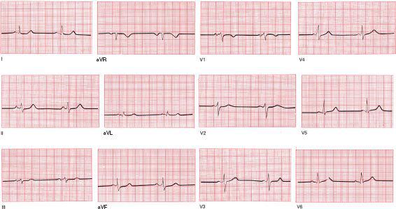 On the opposite page is a normal electrocardiogram or EKG By the time you - photo 4