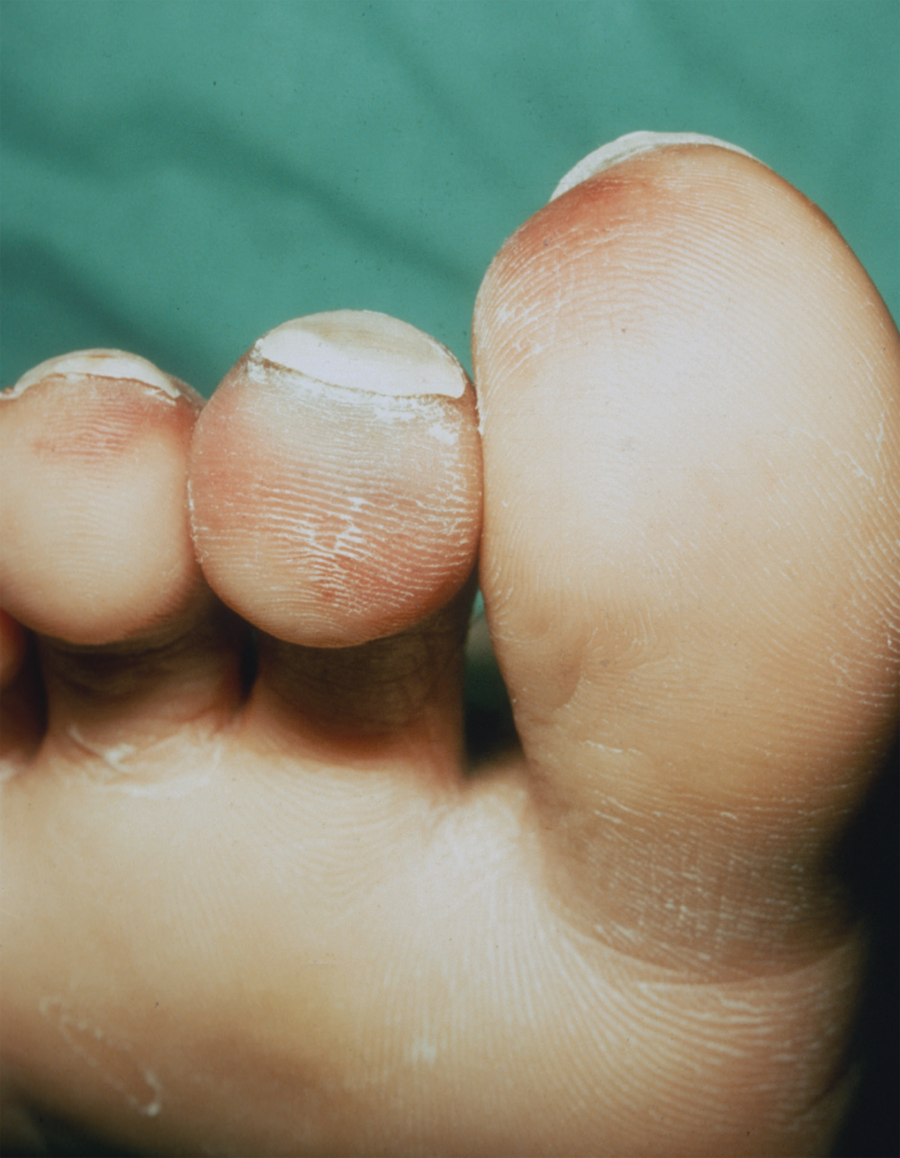 Figure B Violaceous discoloration of the tips of the first three toes - photo 3