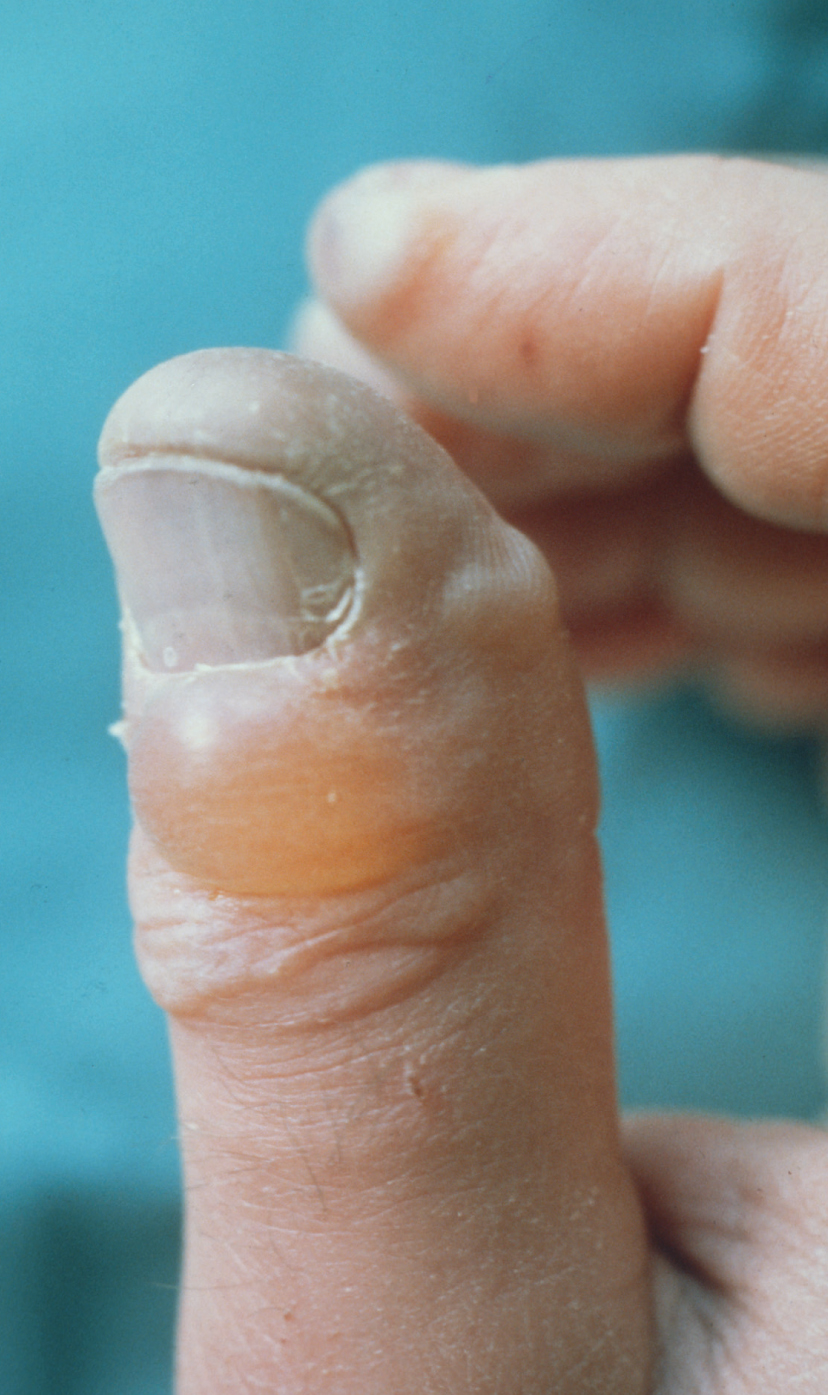 Figure E Bluish discoloration of the thumbnail and fingertips and a blister - photo 6