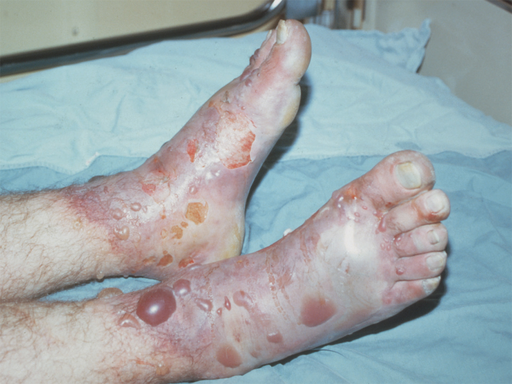 Figure G Bluish discoloration distal areas with no blisters and more - photo 8