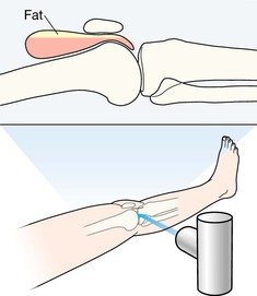 Example 1 Injured knee Patient supine A fatfluid level in the suprapatellar - photo 6