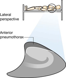 Example 2 A small pneumothorax will usually be detectable at the apex of the - photo 7