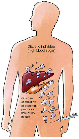 04 Types Of Diabetes Type I Diabetes Type I diabetes is a severe form of - photo 10