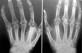 Some diseases which present themselves like arthritis are Osteoporosis - photo 24