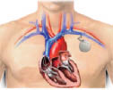 Pacemaker A bone gets splintered or shattered in a fracture - photo 5