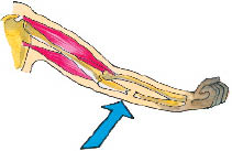 A bone gets splintered or shattered in a fracture Artificial parts - photo 7