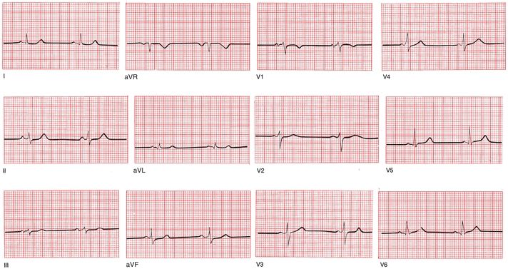 On the opposite page is a normal electrocardiogram or EKG By the time you - photo 4