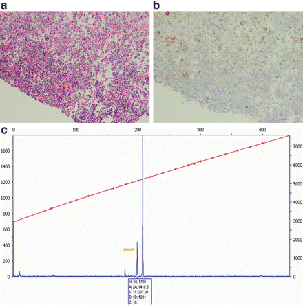 Fig 11 PCR assay for EGFR mutation on cytologic cell block of plural fluid - photo 1