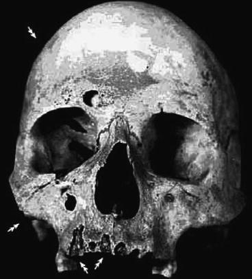 Fig 11 Bronze age skull circa 3500 BCE with subacute osteomyelitis of the - photo 1