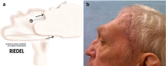 Fig 14 a Schematic depiction of the Reidel procedure whereby the anterior - photo 4