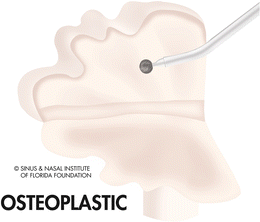 Fig 15 Schematic depiction of the hinged osteoplastic flap with the sinus - photo 5