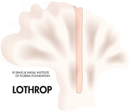 Fig 16 Schematic depiction of the Lothrop procedure indicating the removal of - photo 6