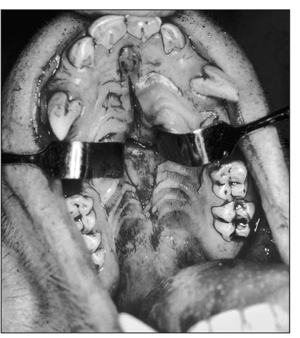 Fig 1-1b Midpalatal sagittal incision for palatal osteotomies Reprinted from - photo 5