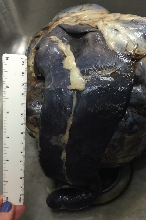 Spleen in the foreground with a large mass attached to the far side that - photo 3