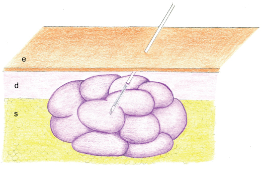 Drawing of a needle biopsy of a skin mass sampling a small proportion of the - photo 5