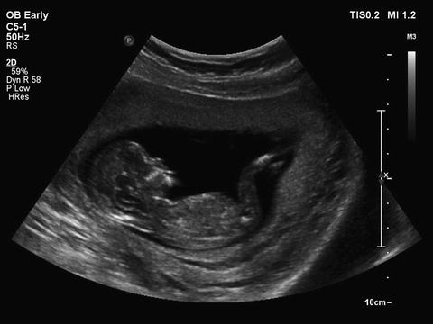 Fig 11 In early pregnancy the entire fetus is within the ultrasound beam - photo 1