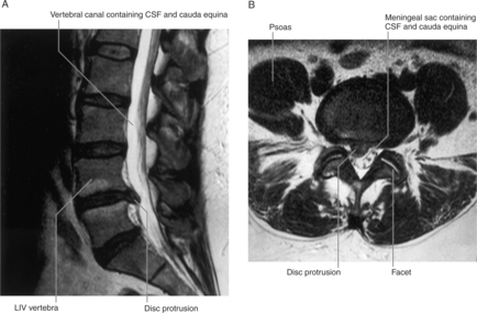 FIGURE 1-1 MRI of a herniated disc between L4 and L5 vertebrae A Sagittal - photo 2