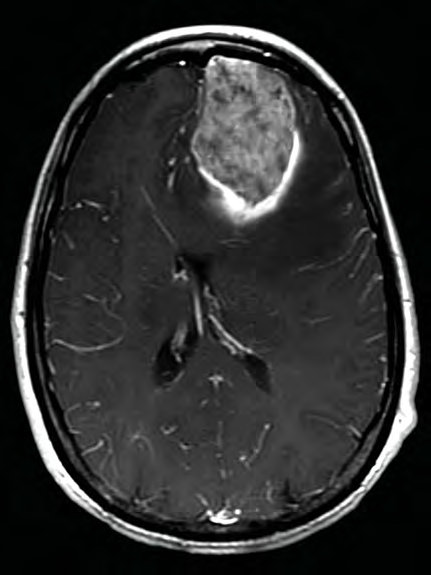 MR scan of Pauls tumor The neurosurgeon explains that gliomas are graded one - photo 6